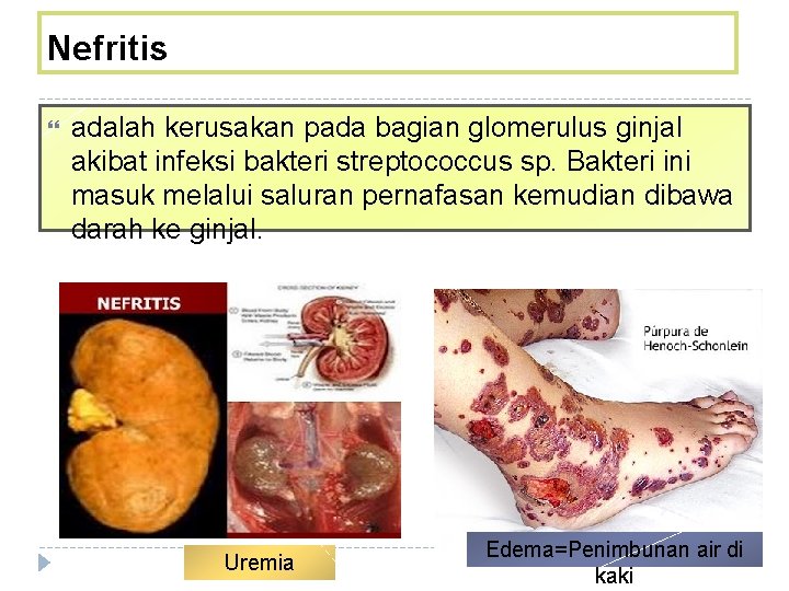 Nefritis adalah kerusakan pada bagian glomerulus ginjal akibat infeksi bakteri streptococcus sp. Bakteri ini