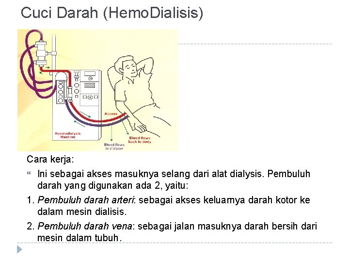 Cuci Darah (Hemo. Dialisis) Cara kerja: Ini sebagai akses masuknya selang dari alat dialysis.