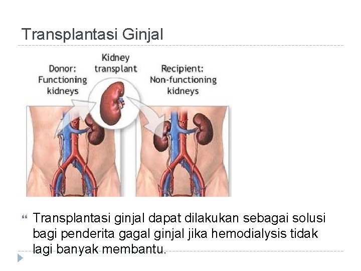 Transplantasi Ginjal Transplantasi ginjal dapat dilakukan sebagai solusi bagi penderita gagal ginjal jika hemodialysis