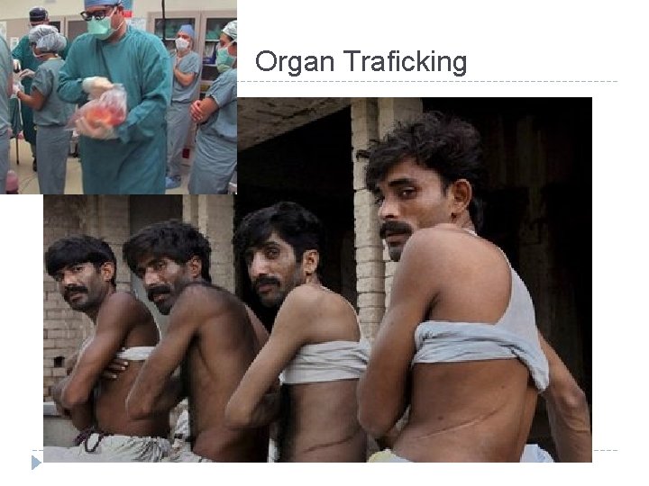 Organ Traficking 