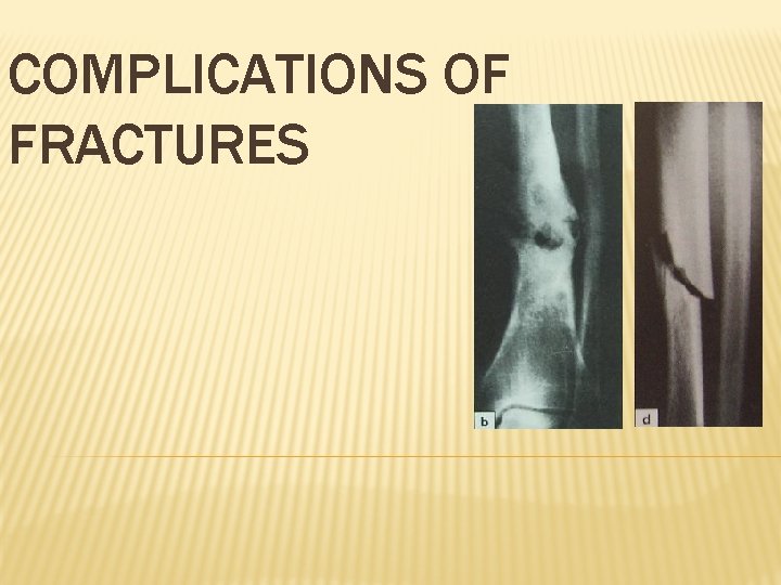 COMPLICATIONS OF FRACTURES 