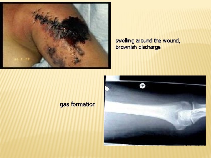 swelling around the wound, brownish discharge gas formation 