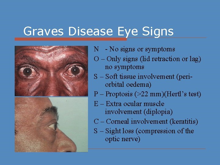 Graves Disease Eye Signs N - No signs or symptoms O – Only signs