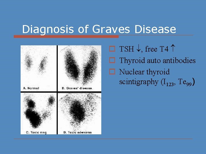 Diagnosis of Graves Disease o TSH , free T 4 o Thyroid auto antibodies