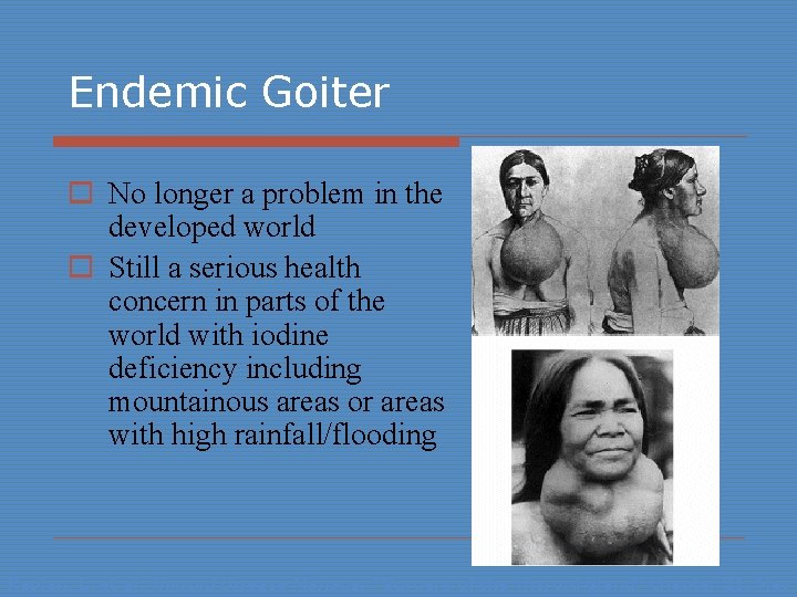 Endemic Goiter o No longer a problem in the developed world o Still a