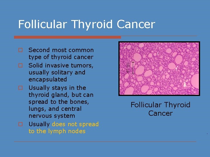 Follicular Thyroid Cancer o Second most common type of thyroid cancer o Solid invasive