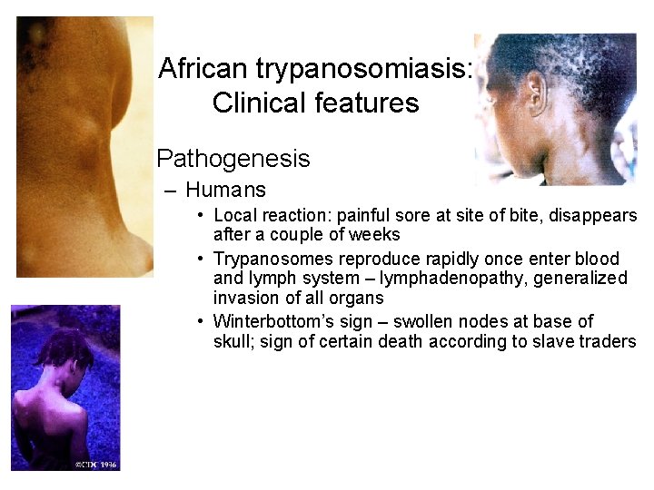African trypanosomiasis: Clinical features • Pathogenesis – Humans • Local reaction: painful sore at