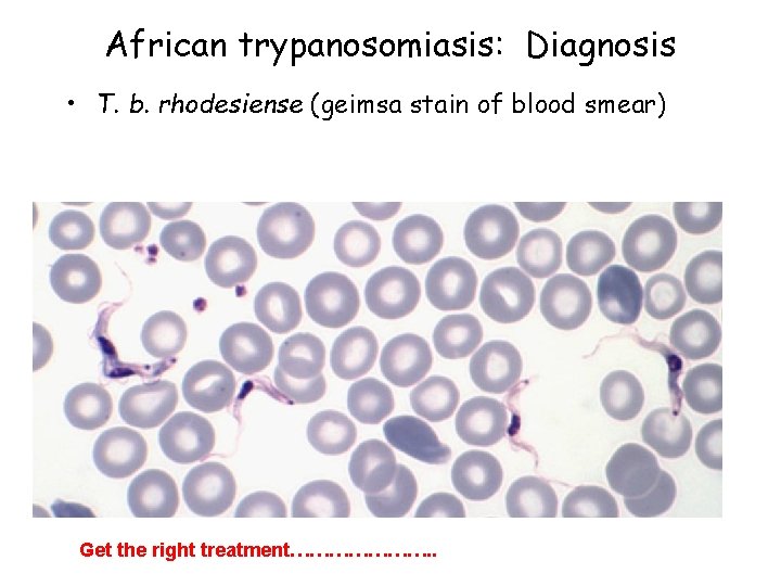 African trypanosomiasis: Diagnosis • T. b. rhodesiense (geimsa stain of blood smear) Get the