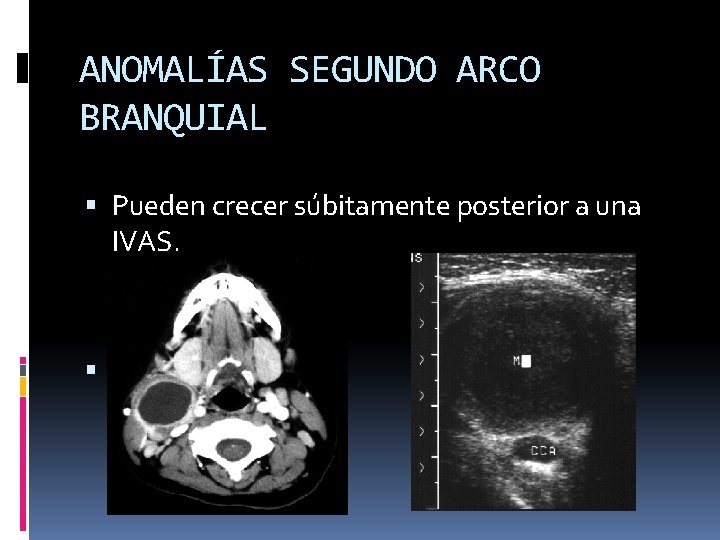 ANOMALÍAS SEGUNDO ARCO BRANQUIAL Pueden crecer súbitamente posterior a una IVAS. quirúrgica 