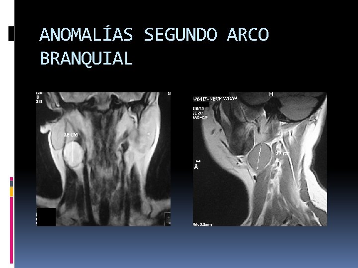 ANOMALÍAS SEGUNDO ARCO BRANQUIAL 