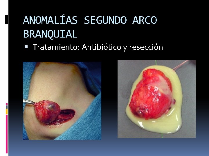 ANOMALÍAS SEGUNDO ARCO BRANQUIAL Tratamiento: Antibiótico y resección 