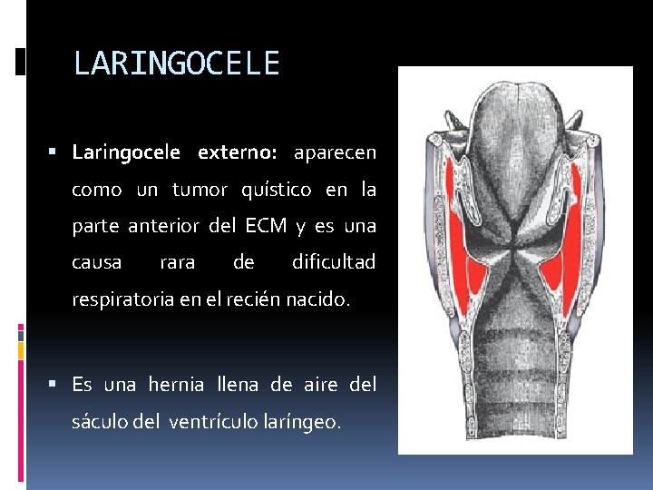 LARINGOCELE Laringocele externo: aparecen como un tumor quístico en la parte anterior del ECM