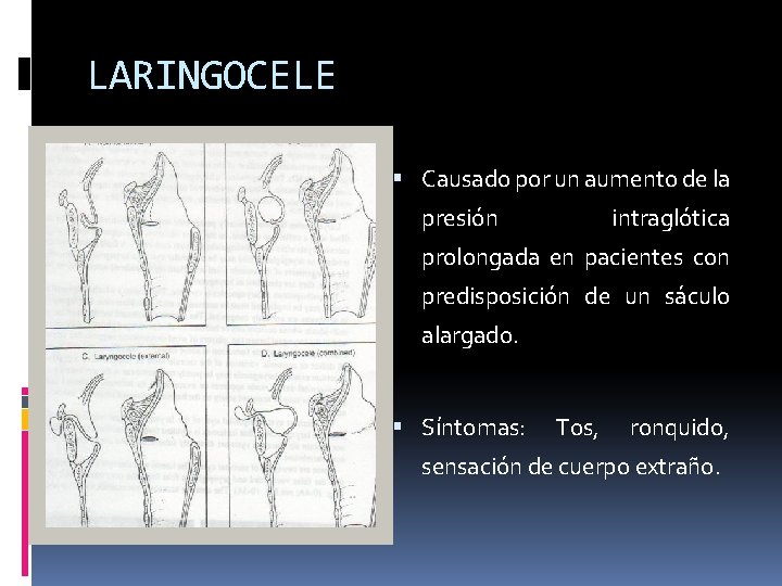 LARINGOCELE Causado por un aumento de la presión intraglótica prolongada en pacientes con predisposición