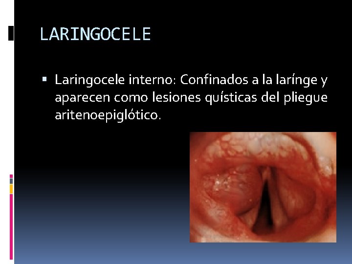 LARINGOCELE Laringocele interno: Confinados a la larínge y aparecen como lesiones quísticas del pliegue