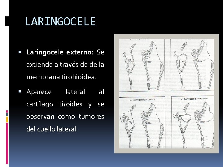 LARINGOCELE Laringocele externo: Se extiende a través de de la membrana tirohioidea. Aparece lateral