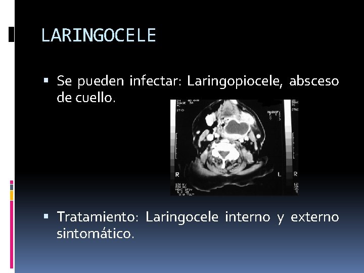 LARINGOCELE Se pueden infectar: Laringopiocele, absceso de cuello. Tratamiento: Laringocele interno y externo sintomático.