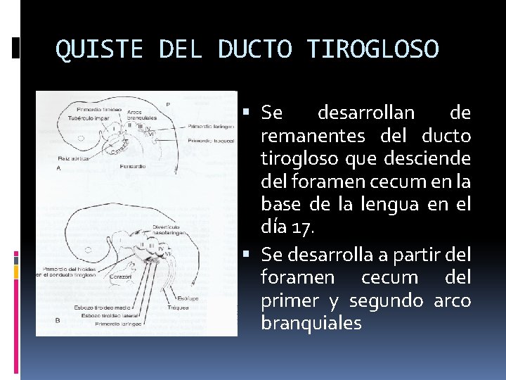 QUISTE DEL DUCTO TIROGLOSO Se desarrollan de remanentes del ducto tirogloso que desciende del