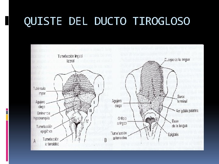 QUISTE DEL DUCTO TIROGLOSO 