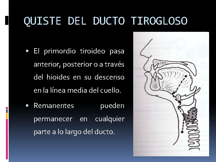 QUISTE DEL DUCTO TIROGLOSO El primordio tiroideo pasa anterior, posterior o a través del