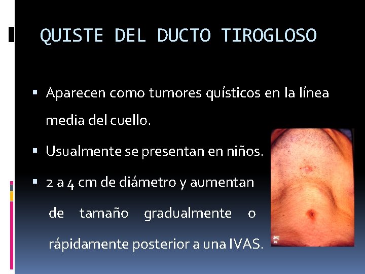 QUISTE DEL DUCTO TIROGLOSO Aparecen como tumores quísticos en la línea media del cuello.