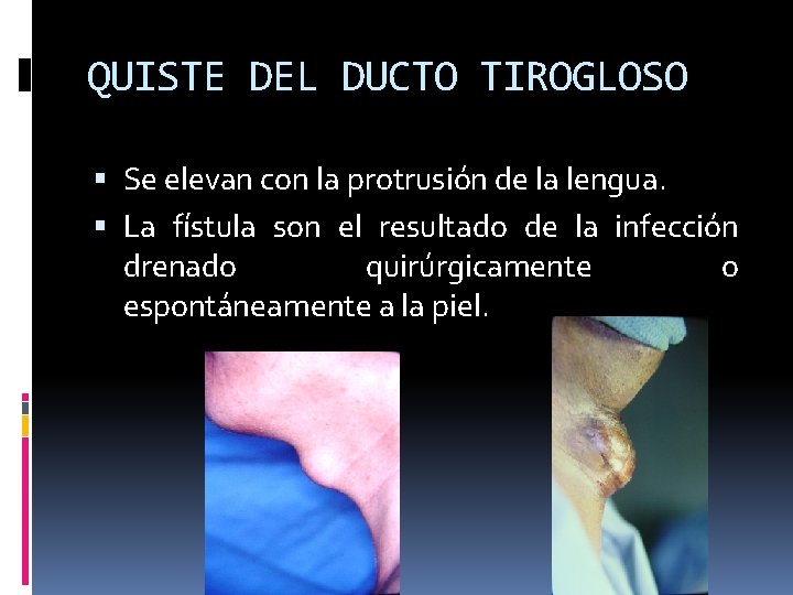 QUISTE DEL DUCTO TIROGLOSO Se elevan con la protrusión de la lengua. La fístula