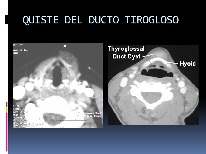 QUISTE DEL DUCTO TIROGLOSO 