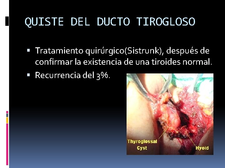 QUISTE DEL DUCTO TIROGLOSO Tratamiento quirúrgico(Sistrunk), después de confirmar la existencia de una tiroides