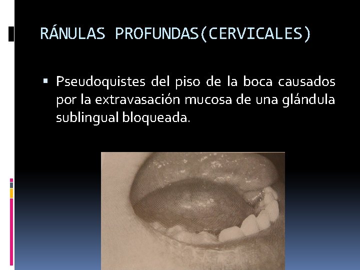 RÁNULAS PROFUNDAS(CERVICALES) Pseudoquistes del piso de la boca causados por la extravasación mucosa de