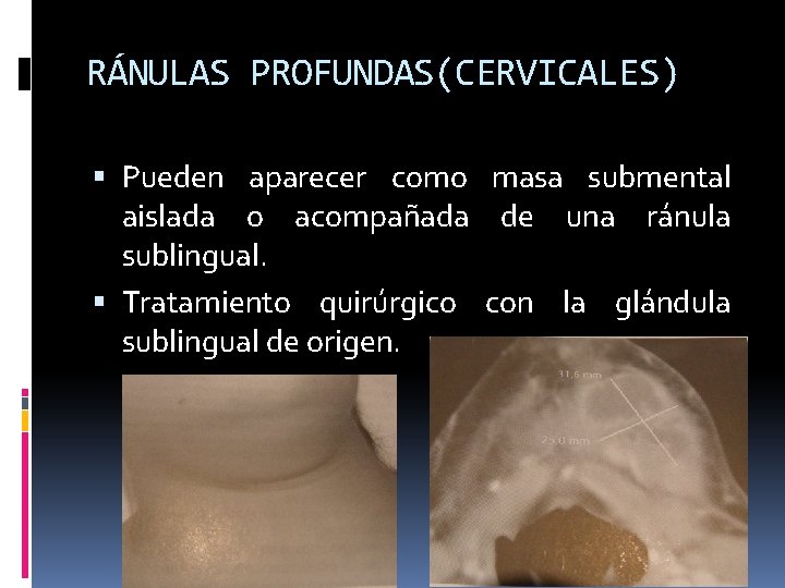 RÁNULAS PROFUNDAS(CERVICALES) Pueden aparecer como masa submental aislada o acompañada de una ránula sublingual.