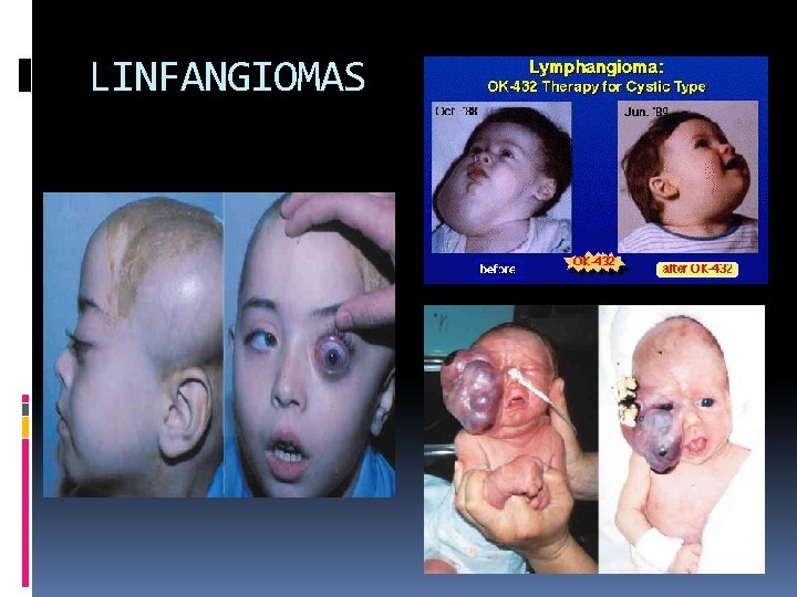 LINFANGIOMAS 