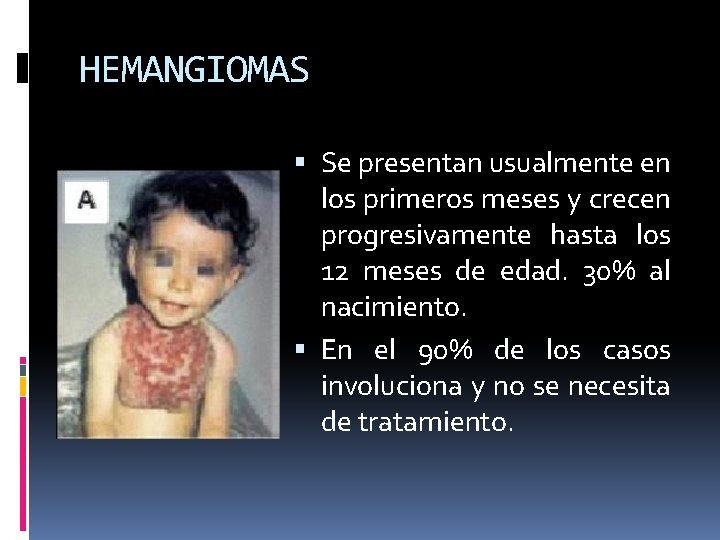 HEMANGIOMAS Se presentan usualmente en los primeros meses y crecen progresivamente hasta los 12