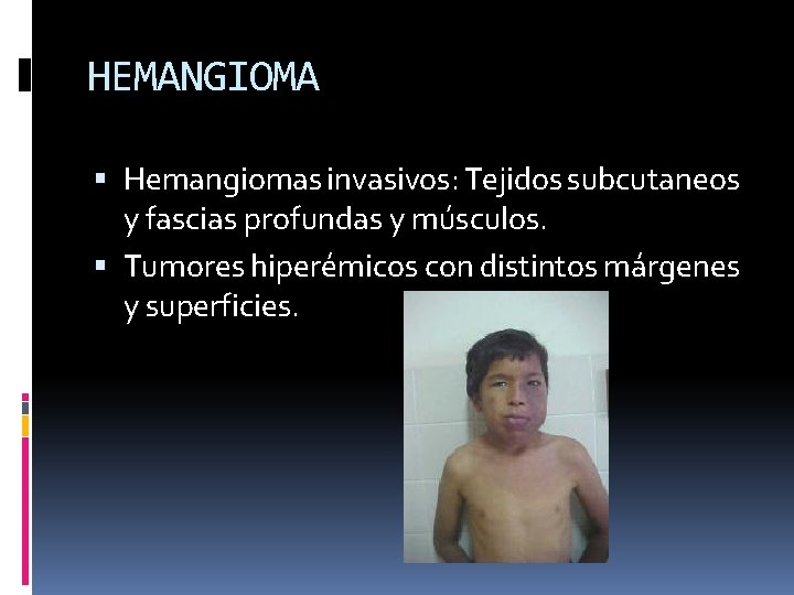 HEMANGIOMA Hemangiomas invasivos: Tejidos subcutaneos y fascias profundas y músculos. Tumores hiperémicos con distintos