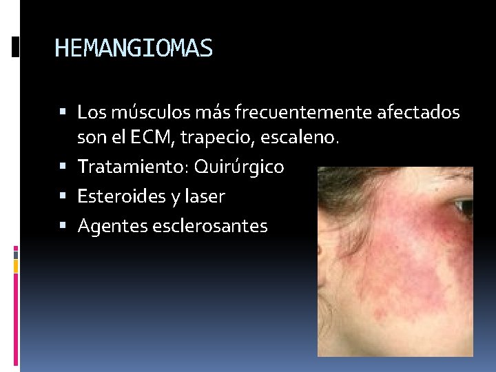 HEMANGIOMAS Los músculos más frecuentemente afectados son el ECM, trapecio, escaleno. Tratamiento: Quirúrgico Esteroides