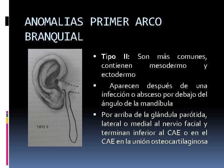 ANOMALIAS PRIMER ARCO BRANQUIAL Tipo II: Son más comunes, contienen mesodermo y ectodermo Aparecen