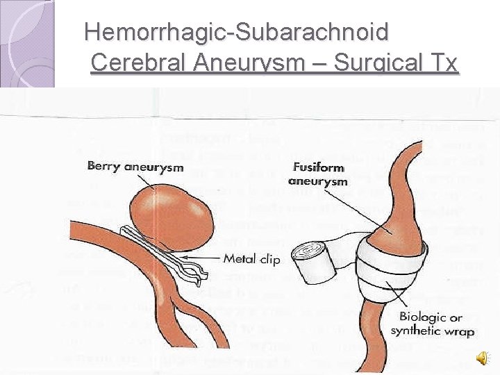 Hemorrhagic-Subarachnoid Cerebral Aneurysm – Surgical Tx 
