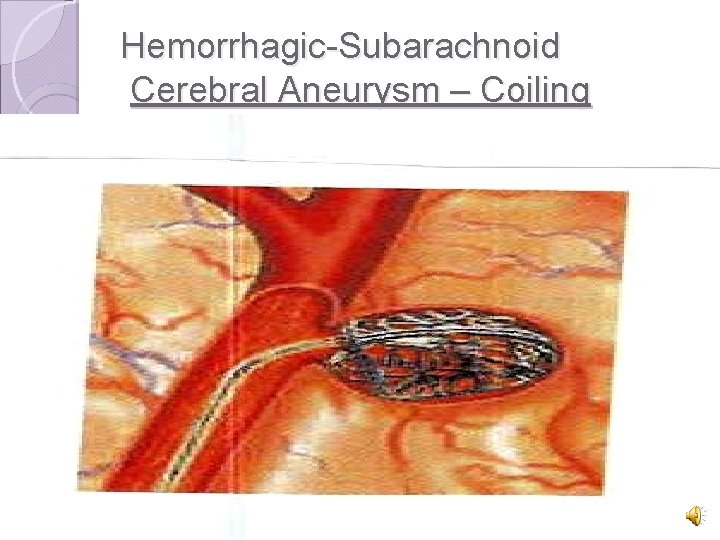 Hemorrhagic-Subarachnoid Cerebral Aneurysm – Coiling 