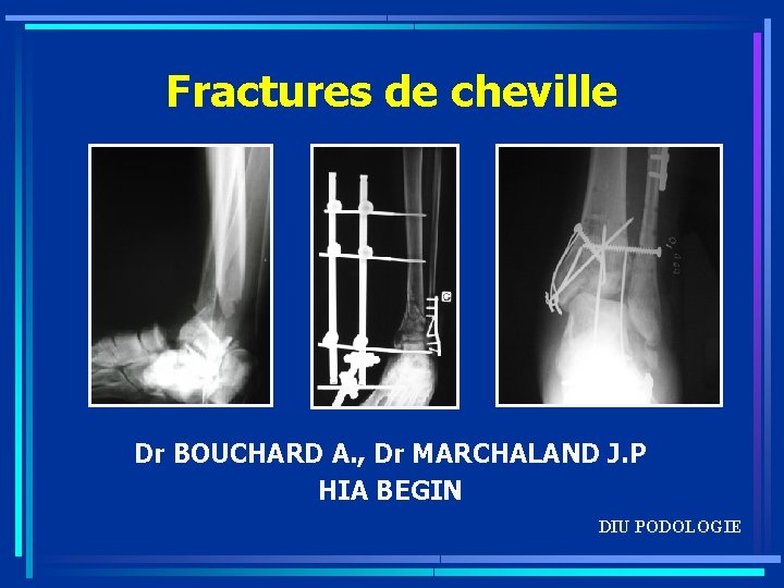 Fractures de cheville Dr BOUCHARD A. , Dr MARCHALAND J. P HIA BEGIN DIU