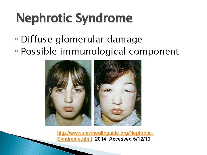 Nephrotic Syndrome Diffuse glomerular damage Possible immunological component http: //www. newhealthguide. org/Nephrotic. Syndrome. html,