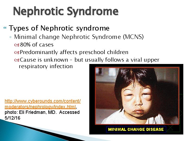 Nephrotic Syndrome Types of Nephrotic syndrome ◦ Minimal change Nephrotic Syndrome (MCNS) 80% of