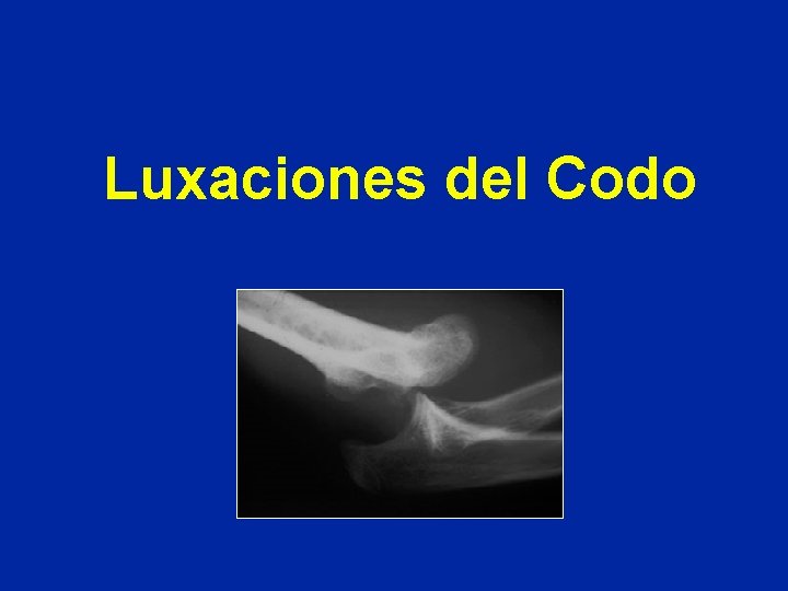 Luxaciones del Codo 
