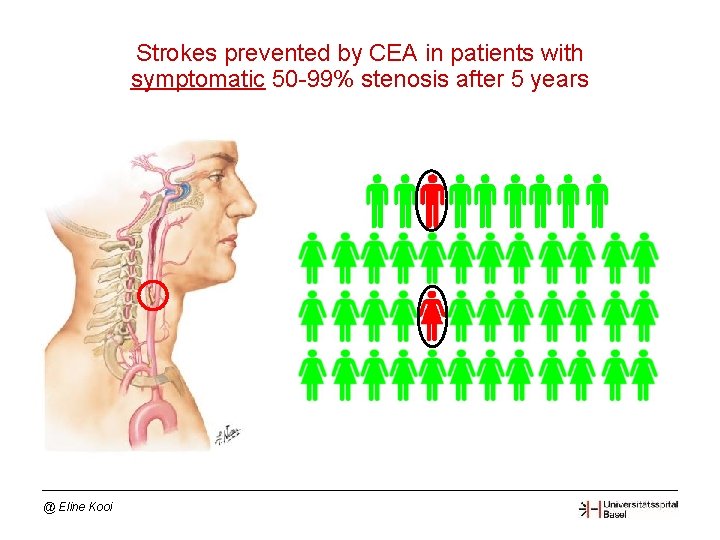 Strokes prevented by CEA in patients with symptomatic 50 -99% stenosis after 5 years