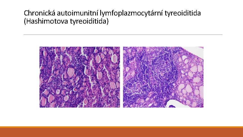 Chronická autoimunitní lymfoplazmocytární tyreoiditida (Hashimotova tyreoiditida) 