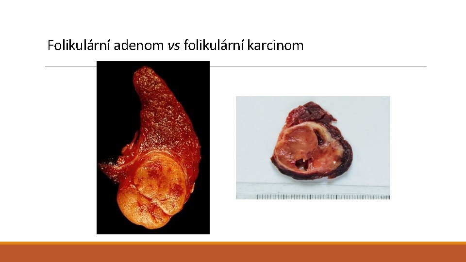 Folikulární adenom vs folikulární karcinom 