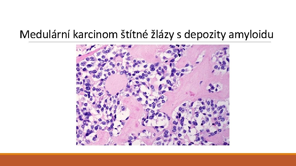 Medulární karcinom štítné žlázy s depozity amyloidu 