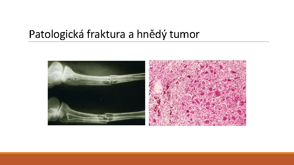 Patologická fraktura a hnědý tumor 