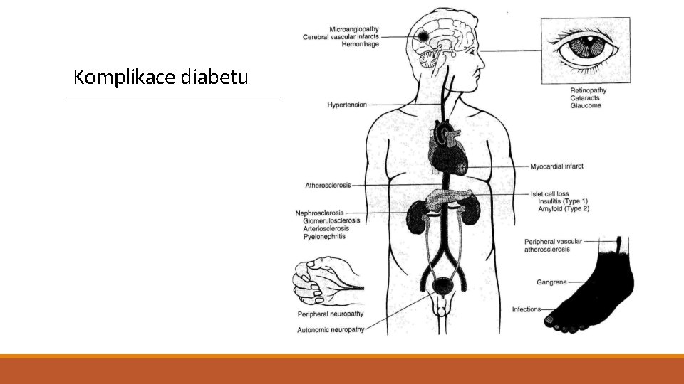 Komplikace diabetu 