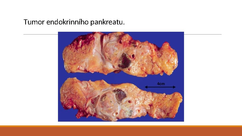 Tumor endokrinního pankreatu. 