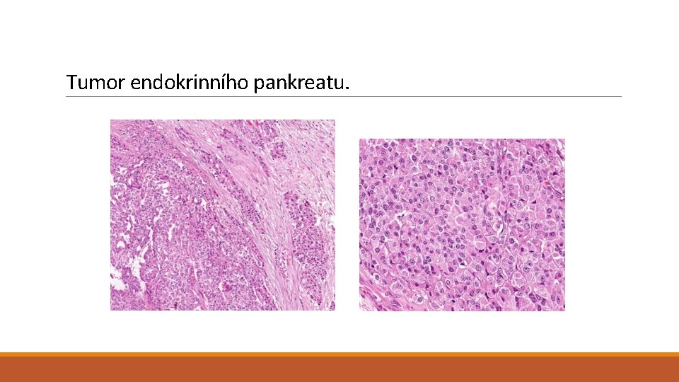 Tumor endokrinního pankreatu. 