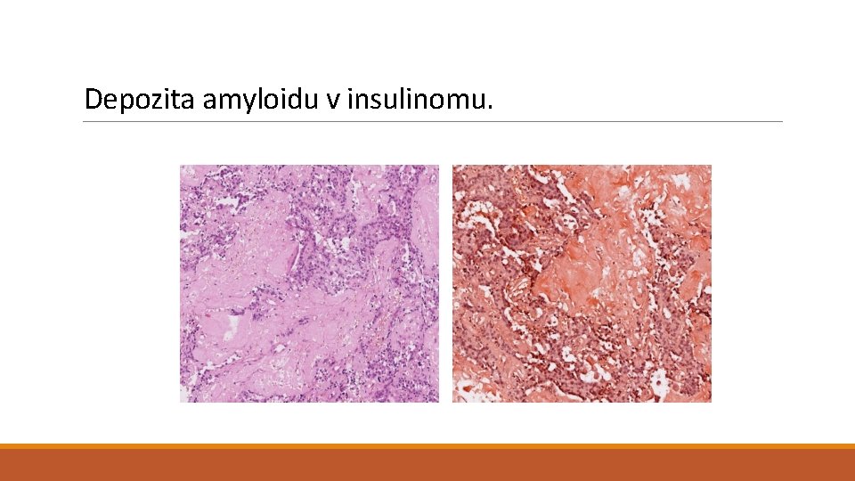 Depozita amyloidu v insulinomu. 