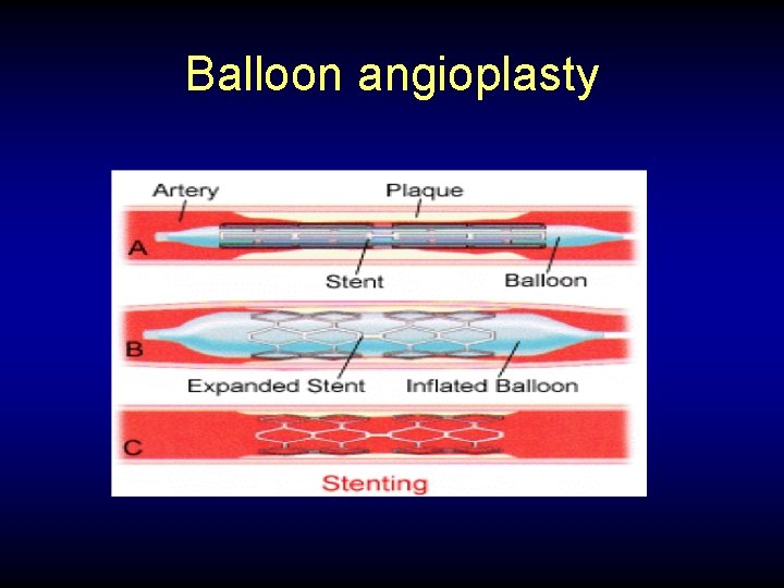 Balloon angioplasty 